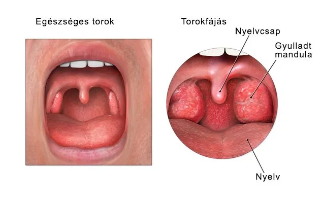 egészséges torok